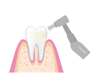 歯の表面をツルツルにお掃除・仕上げ磨きします。